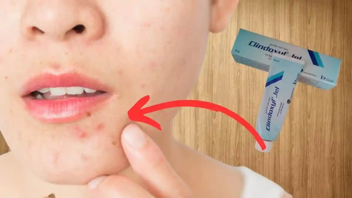 En Etkili Sivilce İlacı Seçenekleri ve Cilt Sağlığını Koruma Yöntemleri