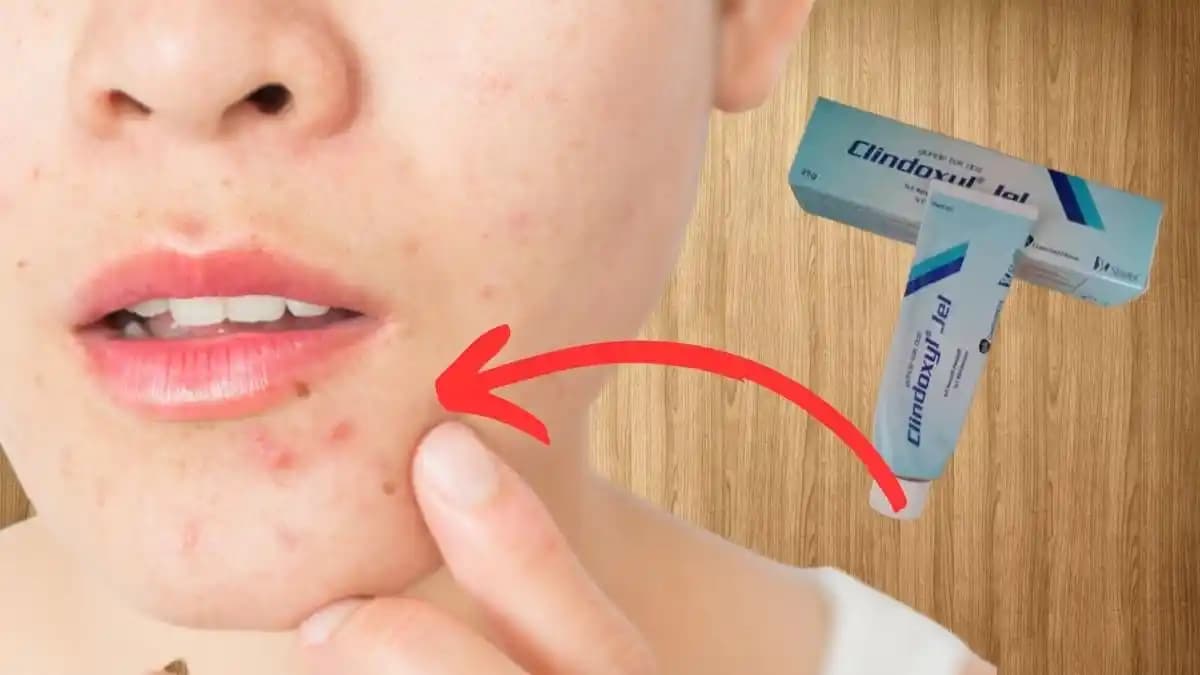 En Etkili Sivilce İlacı Seçenekleri ve Cilt Sağlığını Koruma Yöntemleri