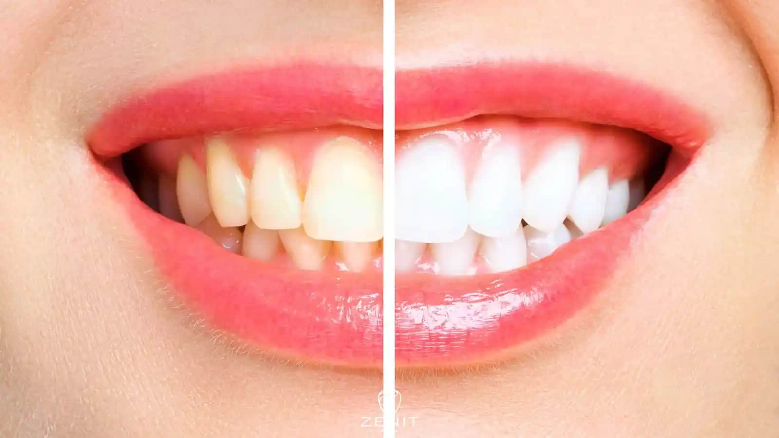 En İyi Diş Beyazlatma Yöntemleri: Güzel ve Sağlıklı Gülüş İçin Bilmeniz Gerekenler