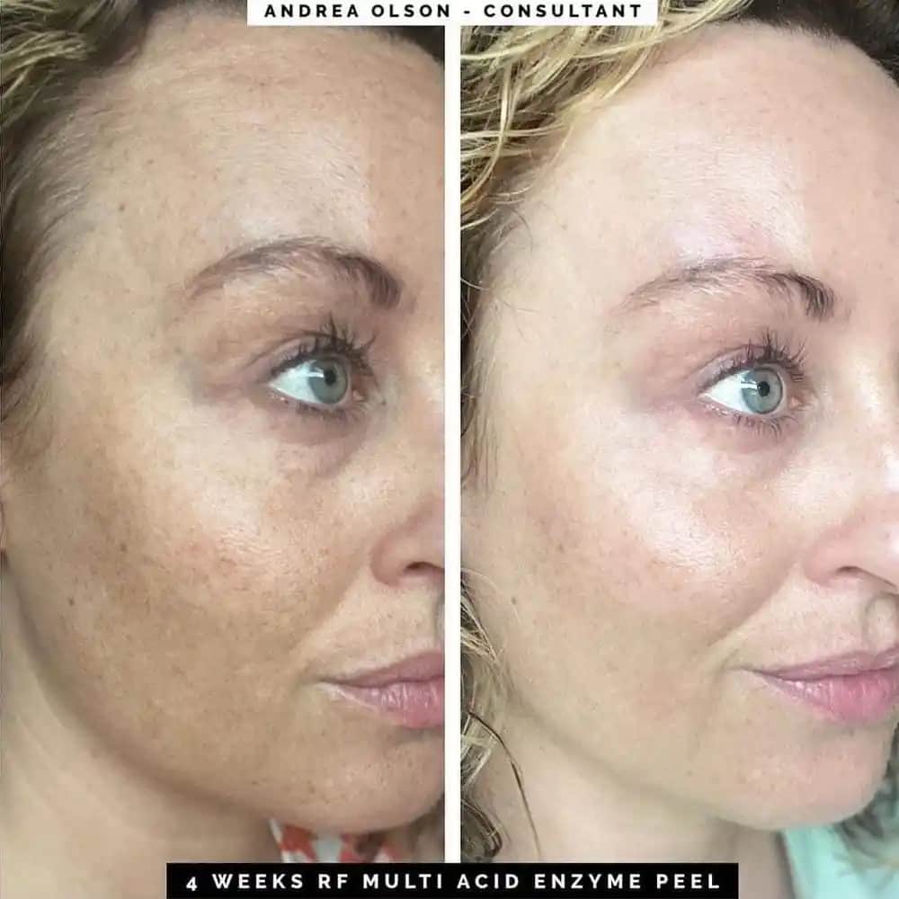 Enzimatik Peeling Nedir ve Cilt Yenilemede Doğal Yöntemler Nelerdir