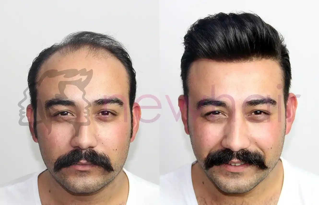 Erkek Protez Saç Nedir ve Estetik Çözüm Olarak Avantajları Nelerdir