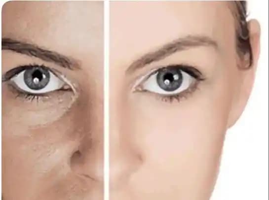 Genç Yaşta Göz Çevresi Kırışıklıklarının Nedenleri ve Etkili Çözüm Yolları