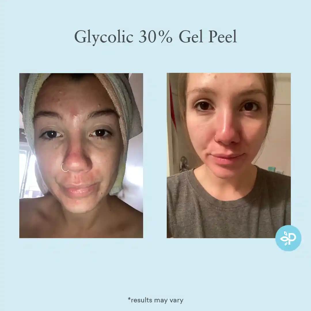 Glikolik Asit Peeling Nedir, Nasıl Uygulanır ve Cilt Sağlığına Faydaları Nelerdir