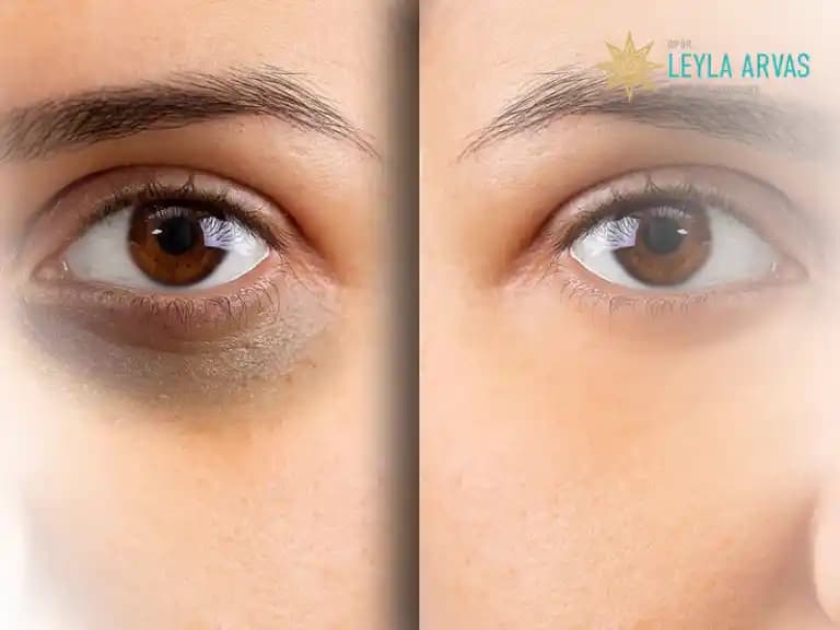 Göz Altı Morluklarına Karşı En Etkili Çözümler ve İpuçları