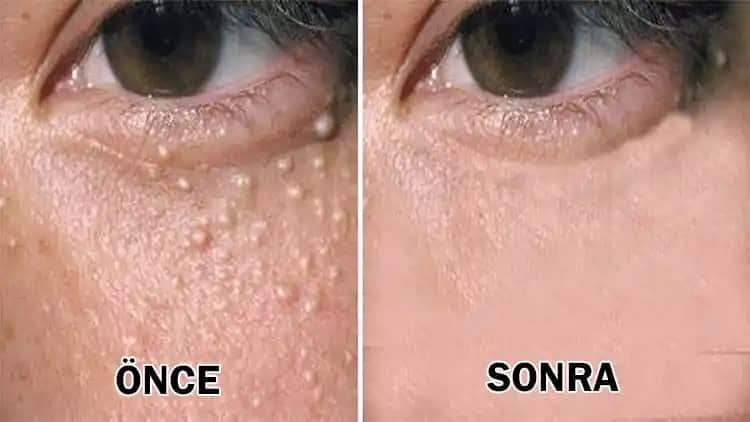 Göz Altı Yağ Bezeleri: Belirtileri, Tedavi Yöntemleri ve Uzman Tavsiyeleri