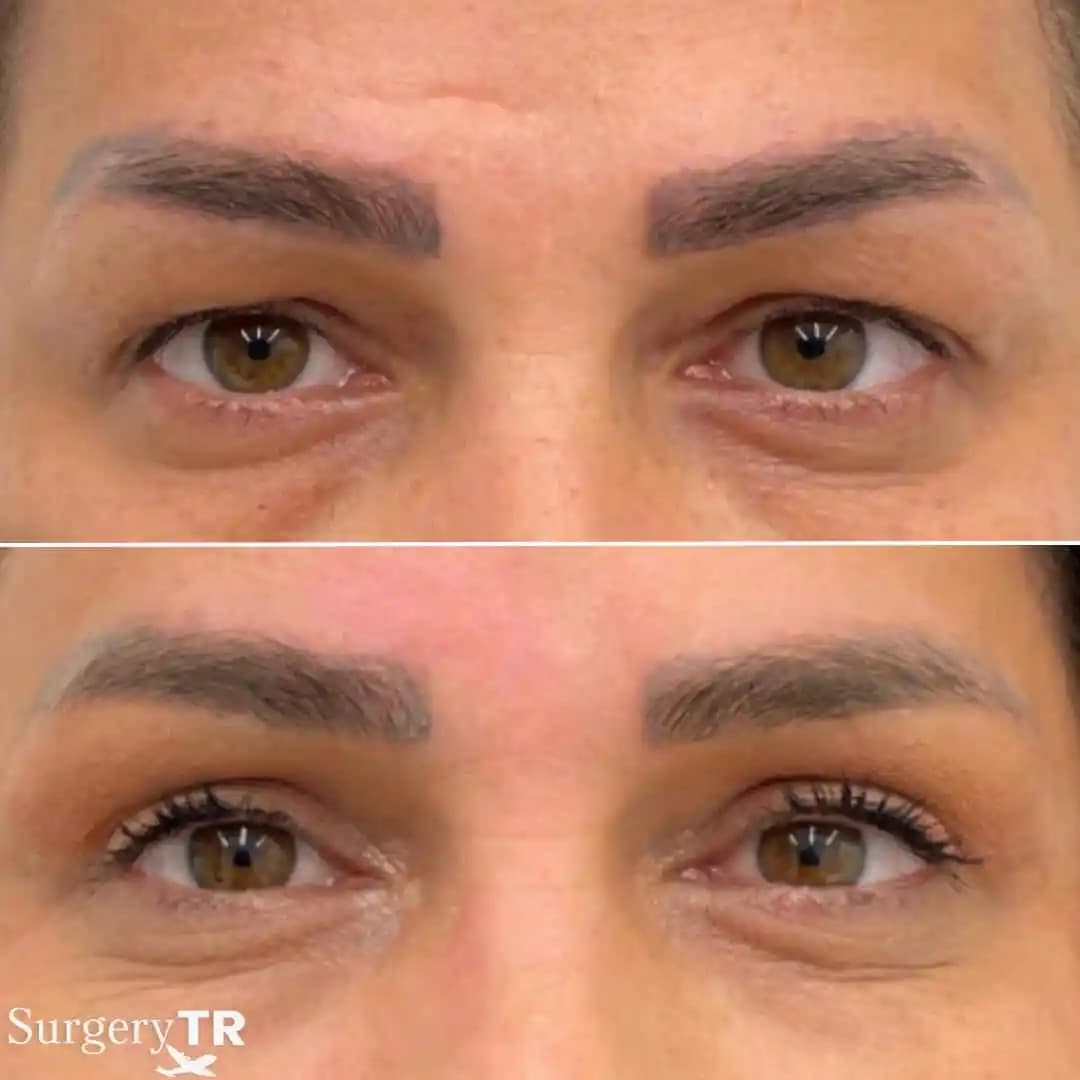 Göz Kapağı Sıkılaştırma Yöntemleri ve Doğal Güzellik Yaklaşımları