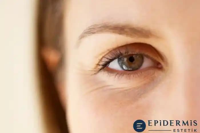Göz Kırışıklıklarına Karşı Doğal ve Medikal Çözümler Hakkında Bilgi