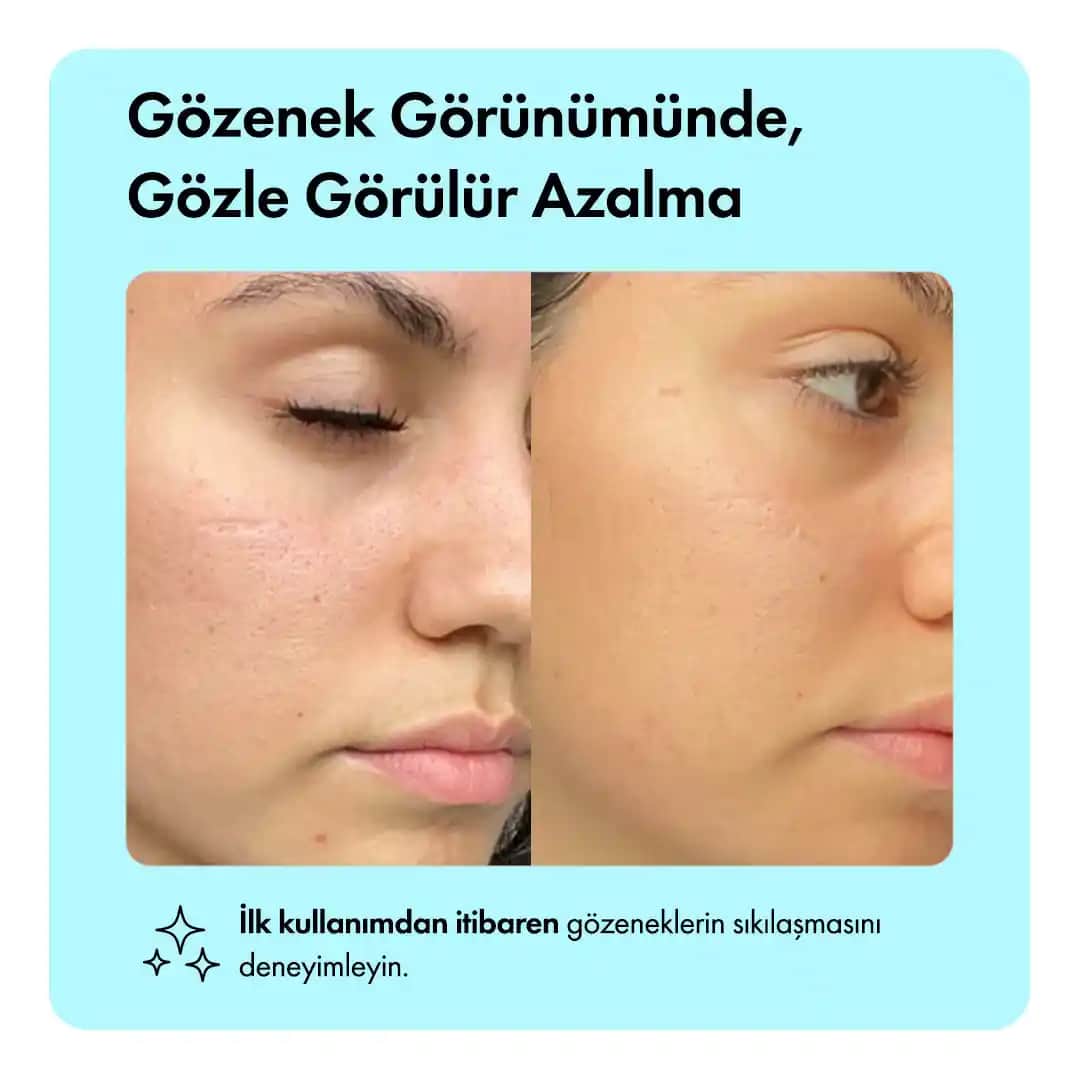 Gözenek Sıkılaştırıcı İşlemler ve Cilt Sağlığını Artıran Yöntemler