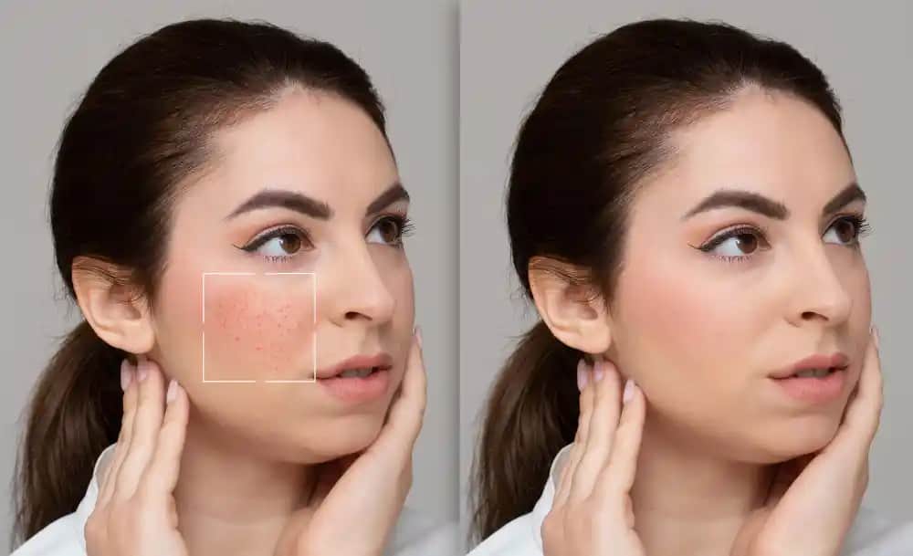 Gözenek Tedavisi ve Cilt Sağlığını Güçlendiren Modern Yöntemler ve Bakım İpuçları