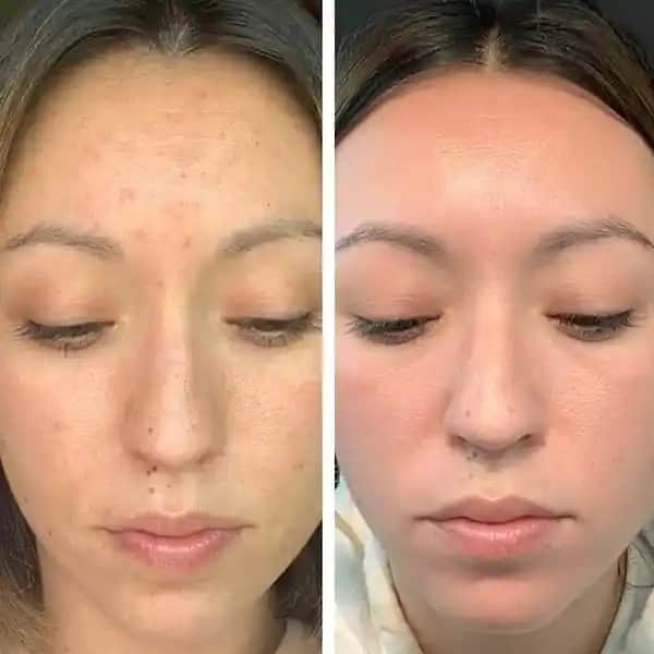 Gözenek Tıkanması Nedir Nasıl Önlenir ve Etkili Çözüm Yolları