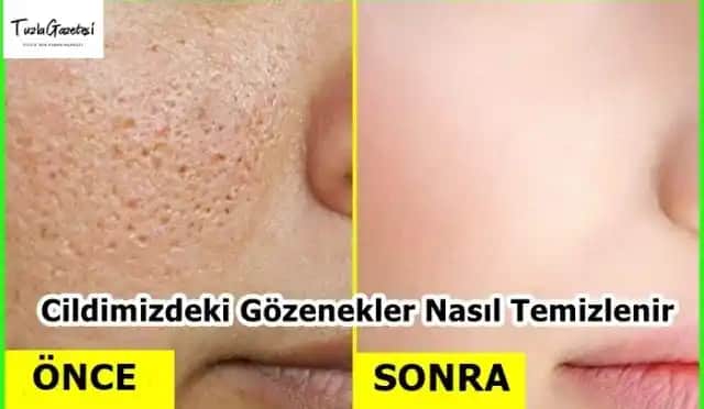 Gözeneklerde Yağ Birikimi ve Temizleme Yöntemleri Cilt Sağlığını Koruma Rehberi