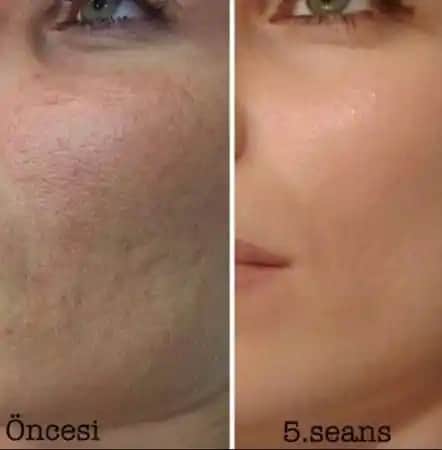 Gözenekleri Kapatmanın En Etkili Yolları ve İpuçları Cilt Sağlığı İçin Bilmeniz Gerekenler