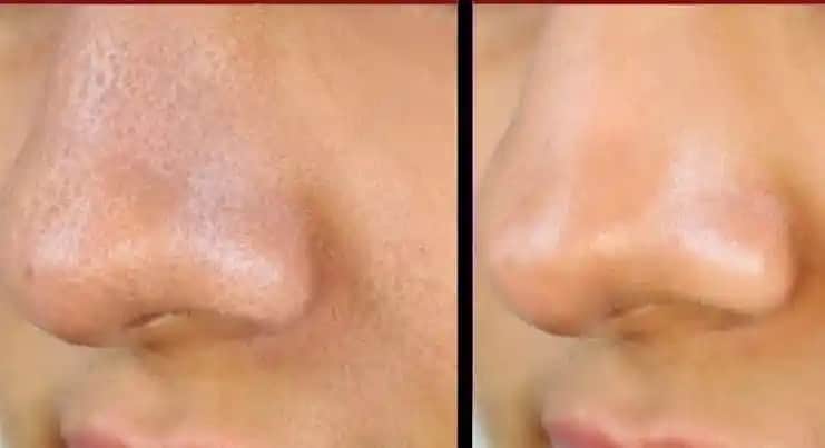 Gözenekli Burun Sorunu ve Etkili Bakım Yöntemleri