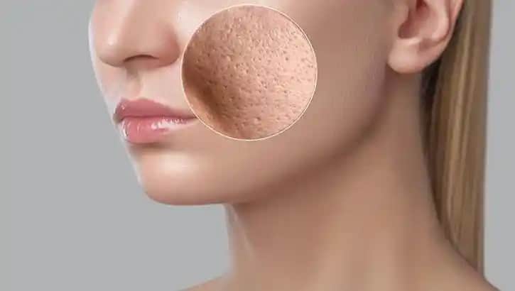 Gözenekli Cilt Nedenleri, Bakım Yöntemleri ve Doğru Ürün Seçimi Rehberi