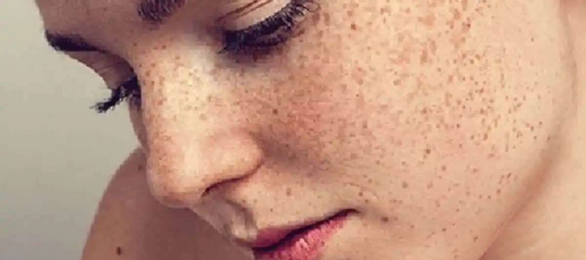 Güneş Lekeleri Nedenleri, Önleme Yöntemleri ve Etkili Çözüm Tavsiyeleri