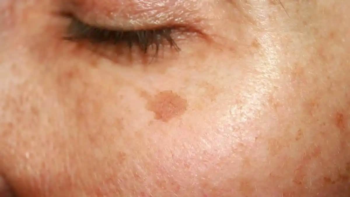 Güneş Lekeleri Nedir Nasıl Giderilir Güneş Koruma ve Cilt Bakımı Yöntemleri