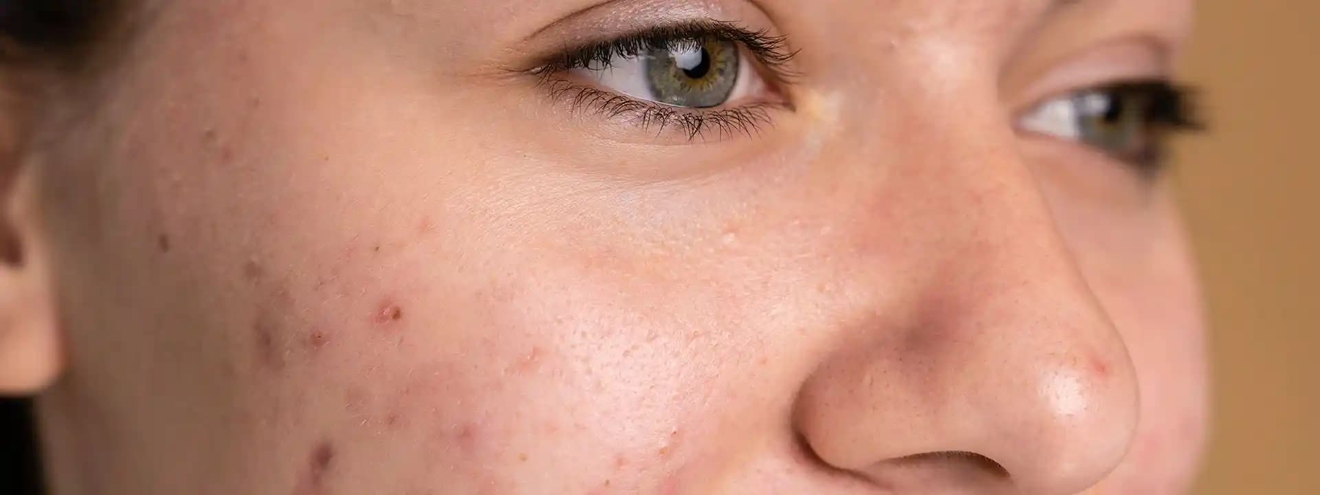 Kapalı Gözenekler ve Cilt Sağlığı: Etkili Bakım Yöntemleri ve Uzman Tavsiyeleri