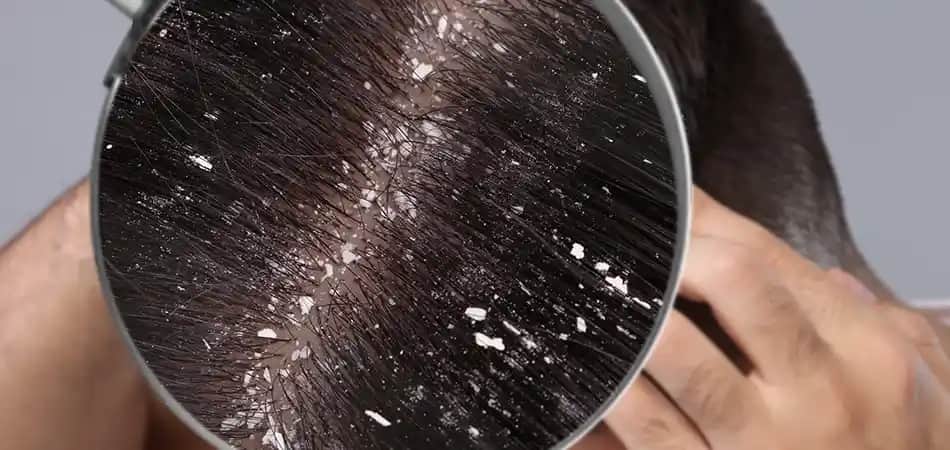 Kepeğe Karşı En Etkili Doğal Yağlar ve Kullanım İpuçları