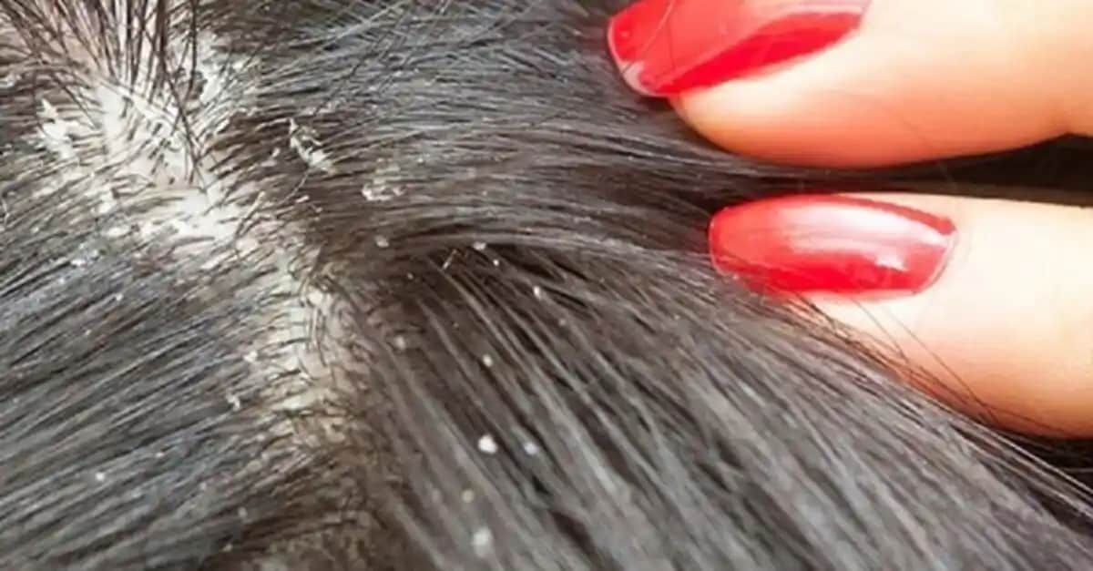 Kepeğe Karşı Etkili ve Kalıcı Çözüm Yöntemleriyle Saç Derisi Sağlığını Koruma