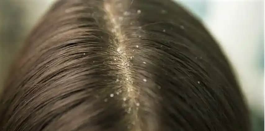 Kepeklenmeye Karşı Doğal ve Etkili Çözüm Yöntemleri ve Saç Bakım İpuçları