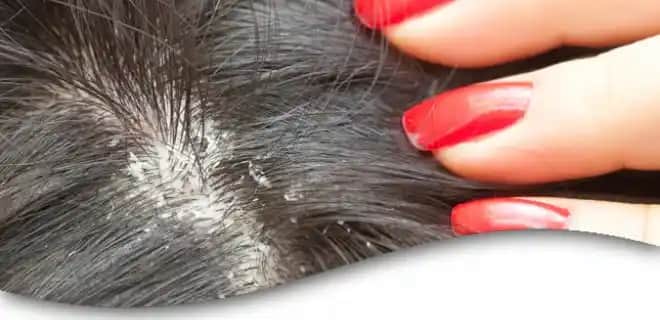 Kepekli Saç Sorunu ve Çözüm Yolları: Sağlıklı ve Parlak Saçlar İçin İpuçları