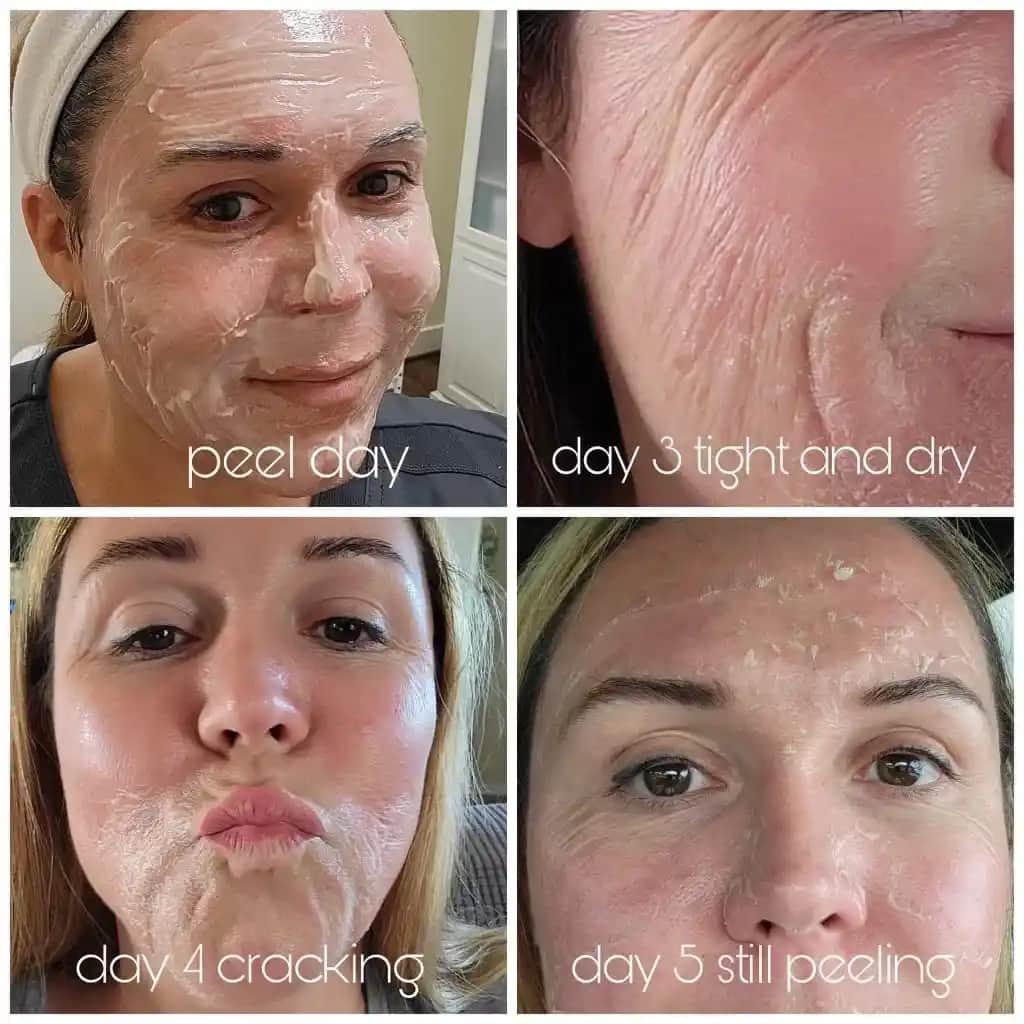 Yüz Peelingi Nedir, Çeşitleri ve Cilt Sağlığına Faydaları Hakkında Bilgiler