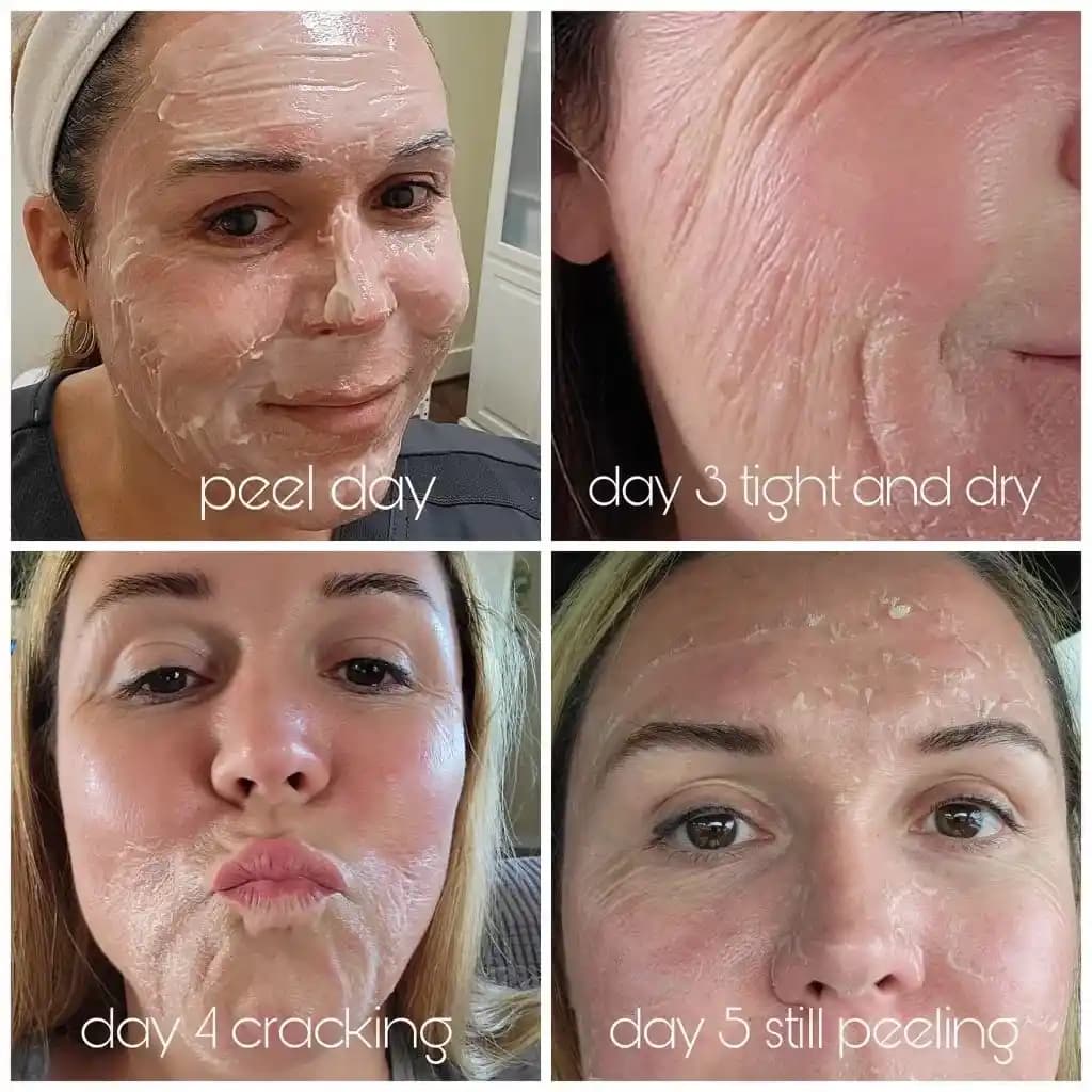 Yüz Peelingi Nedir, Çeşitleri ve Cilt Sağlığına Faydaları Hakkında Bilgiler