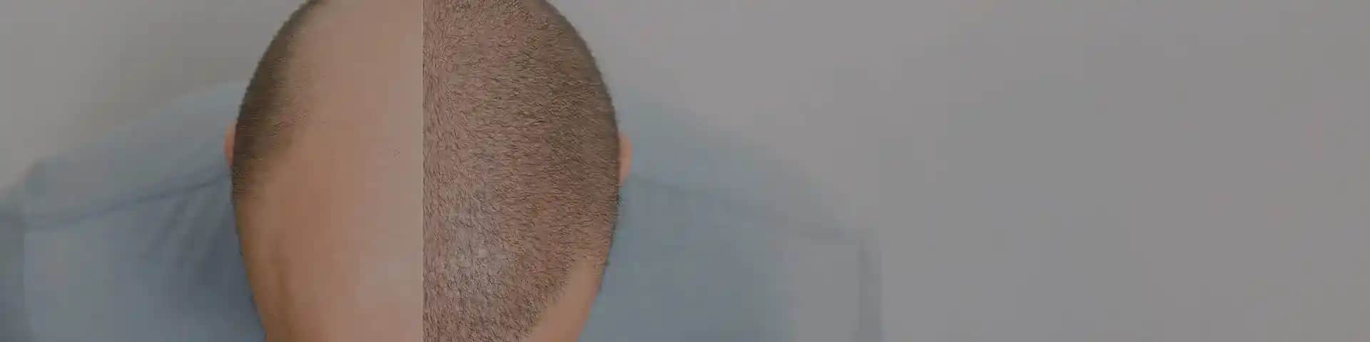 Bioxcin ve Saç Ekimi Öncesi ve Sonrası Bakım Süreçleri Hakkında Detaylar