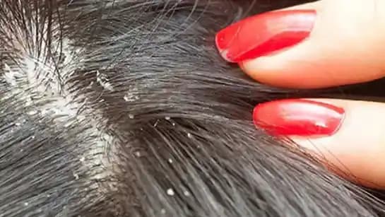 Bit Şampuanlarının Saç Dökülmesine Etkisi ve Güvenli Kullanım Yöntemleri