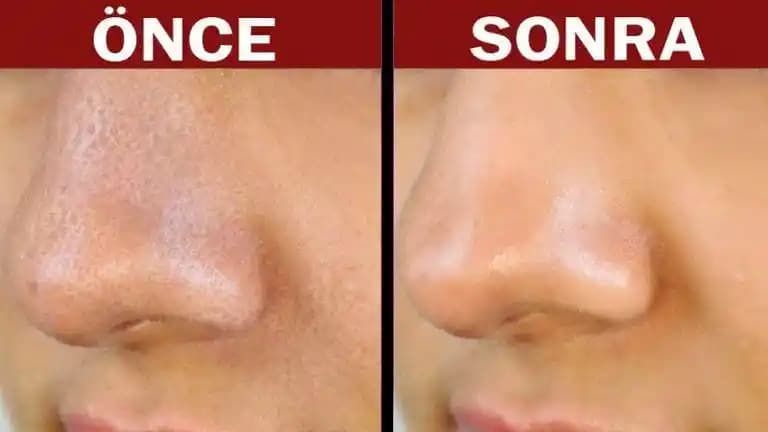 Burun Üstü Gözenek Sıkılaştırıcı Yöntemler ve Cilt Sağlığını Destekleyen İpuçları