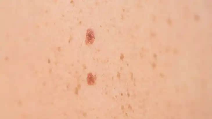 Burunda Güneş Lekeleri Nedenleri, Tedavi Yöntemleri ve Korunma İpuçları