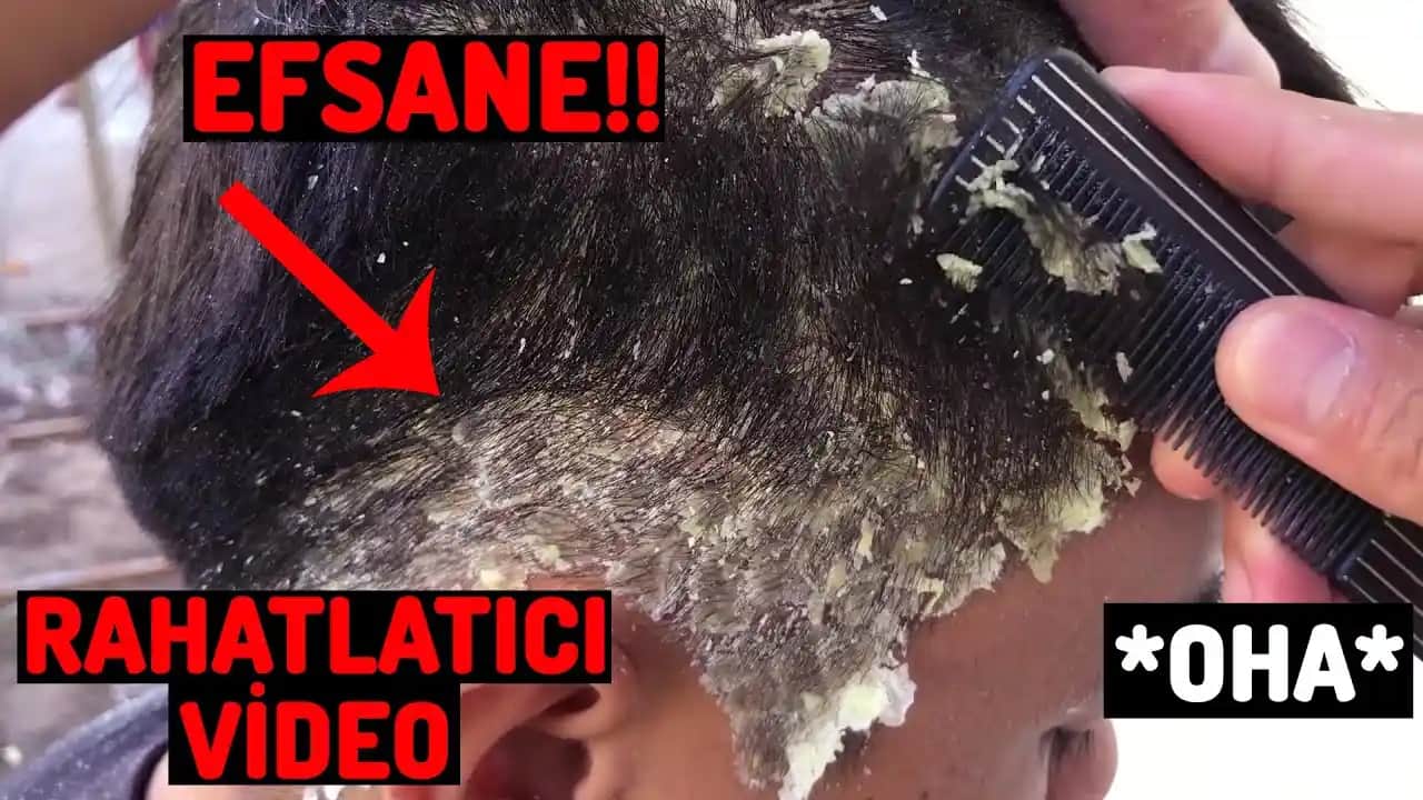 Büyük Kepek Sorunu ve Kozmetik Çözüm Yolları: Etkili Tedavi ve Bakım İpuçları