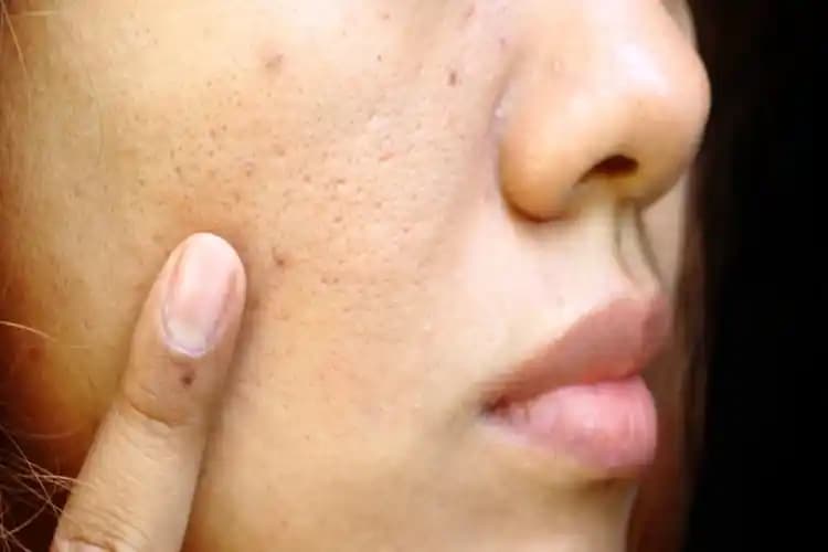 Büyük Siyah Nokta ve Cilt Sağlığı Üzerindeki Etkileri ile Etkili Mücadele Yöntemleri