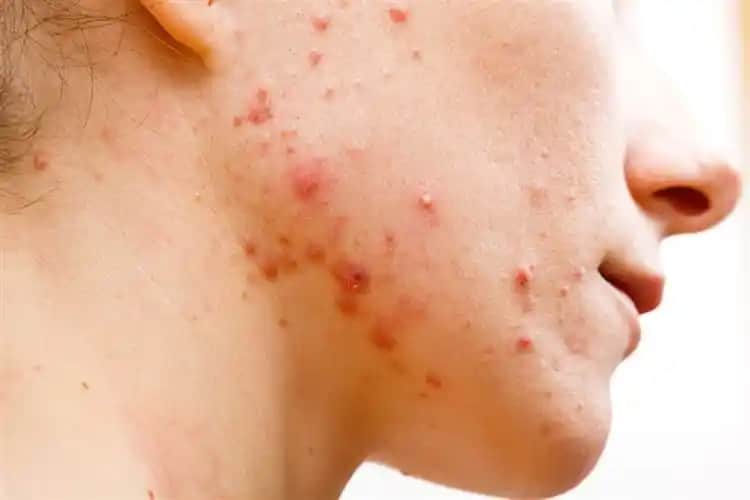 C Vitamini ve Sivilce İlişkisi: Doğru Kullanım ile Cilt Sağlığını Destekleme