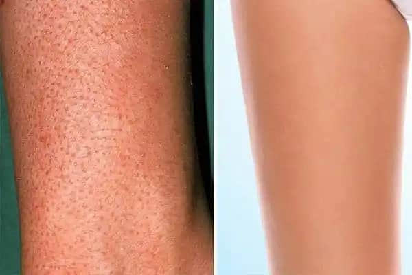 Çilek Bacak Nedir Nasıl Giderilir Kozmetik ve Medikal Yöntemler