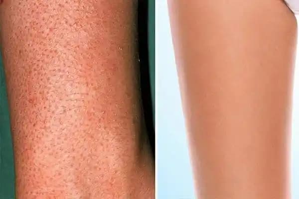 Çilek Bacak Nedir Nasıl Giderilir Kozmetik ve Medikal Yöntemler