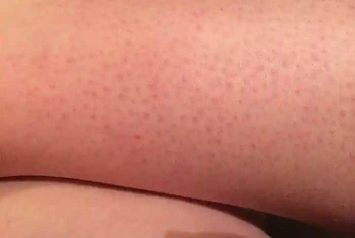 Çilek Bacak Nedir, Neden Olur ve Nasıl Geçer? Etkili Çözüm Yolları