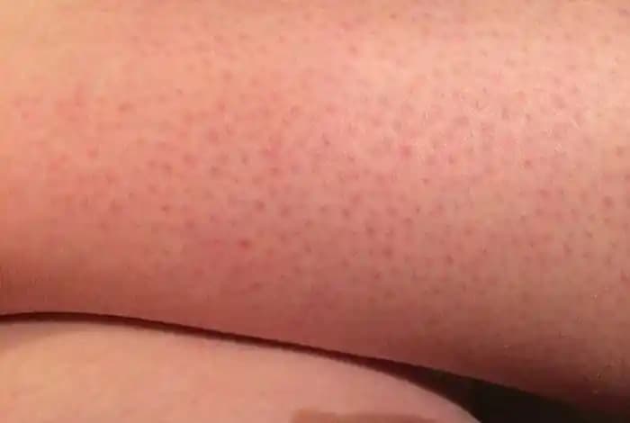 Çilek Bacak Nedir, Neden Olur ve Nasıl Geçer? Etkili Çözüm Yolları