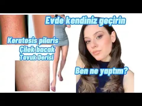 Çilek Derisi (Tavuk Derisi) Nedir Nasıl Giderilir ve Bakım Yöntemleri