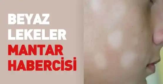 Cilt Mantarı ve Beyaz Lekelerin Nedenleri, Belirtileri ve Tedavi Yöntemleri