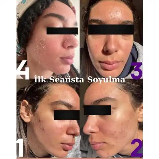 Cilt Peelingi Nedir, Çeşitleri ve Doğru Uygulama Yöntemleri Hakkında Uzman Tavsiyeleri