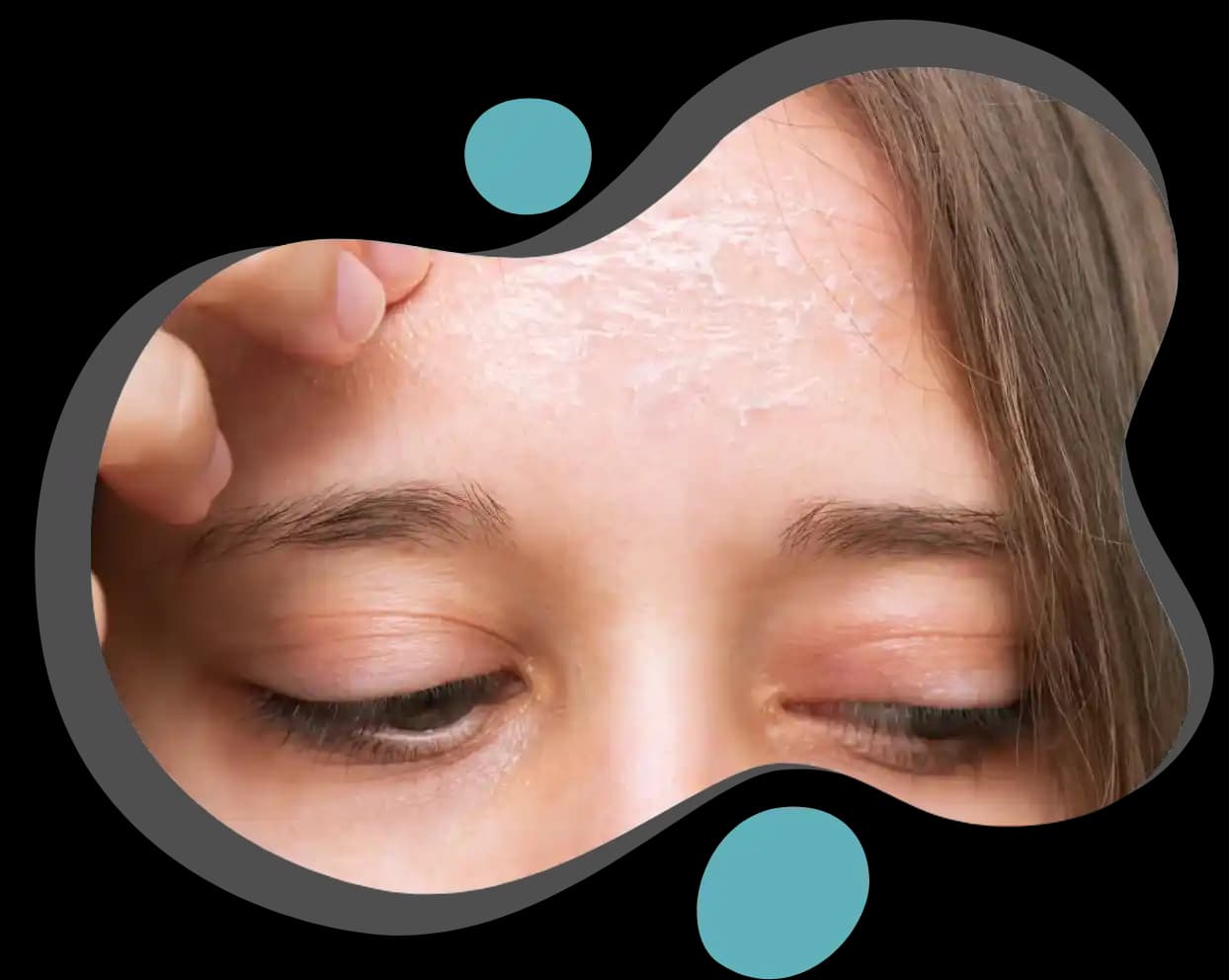 Cilt Pullanmasına Karşı Etkili ve Doğal Çözüm Yöntemleri Rehberi