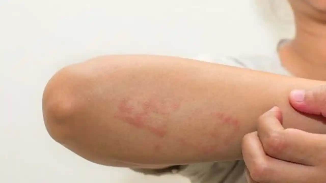 Ciltte Kepeklenmenin Nedenleri Belirtileri ve Etkili Çözüm Yöntemleri