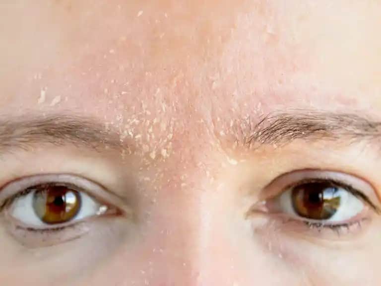 Ciltte Kuruluk ve Pullanma Sorunlarının Nedenleri ve Çözüm Yolları