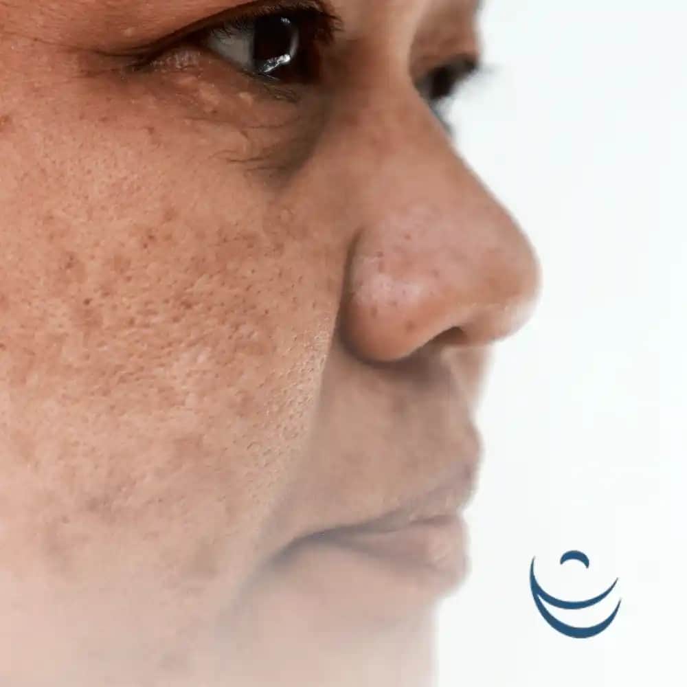 Ciltte Leke Oluşumu Nedenleri Türleri ve Korunma Yöntemleri