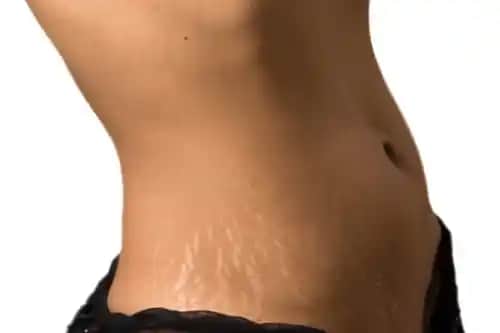 Ciltteki Çatlaklar Nedir, Nedenleri ve Modern Tedavi Yöntemleri Hakkında Detaylı Bilgi