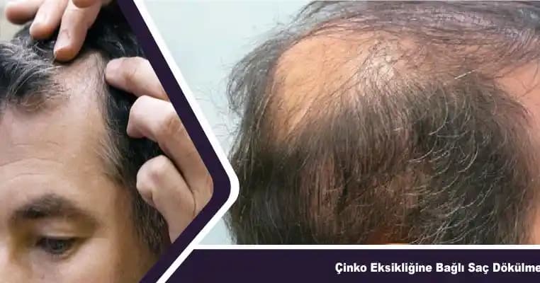 2025'te Çinko ile Saç Dökülmesine Son: Bilmeniz Gereken 5 Kritik Nokta