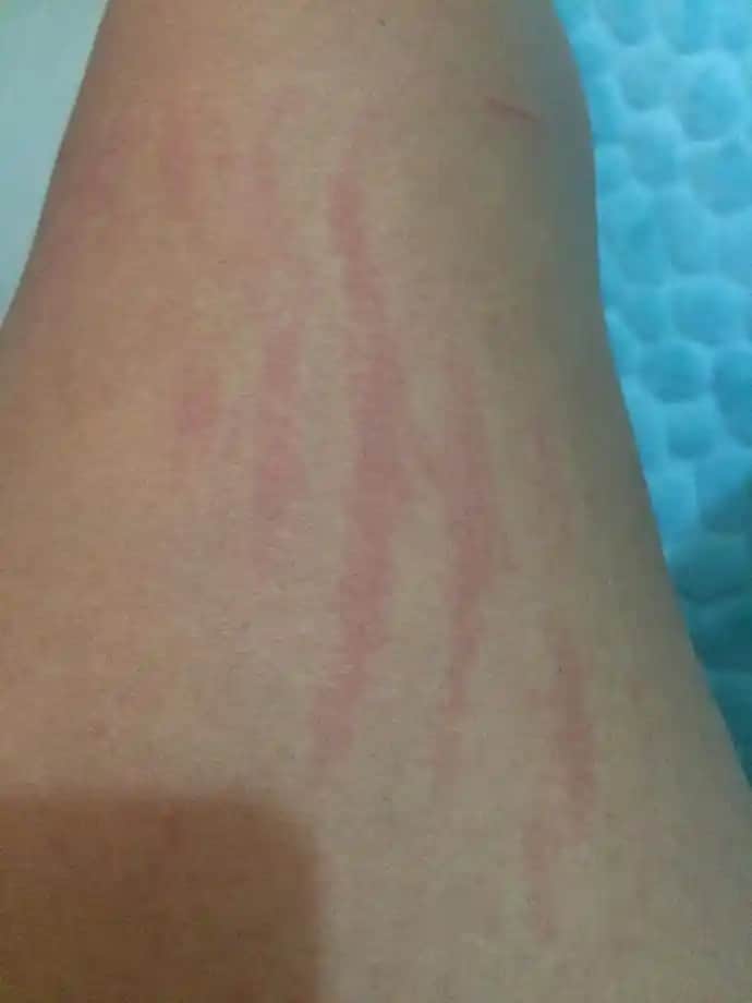 Çizgi Şeklinde Kızarıklıkların Nedenleri ve Etkili Tedavi Yöntemleri