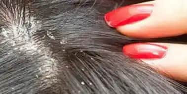 Çocuklarda Kepek Sorunu ve Etkili Tedavi Yöntemleri Uzman Tavsiyeleriyle