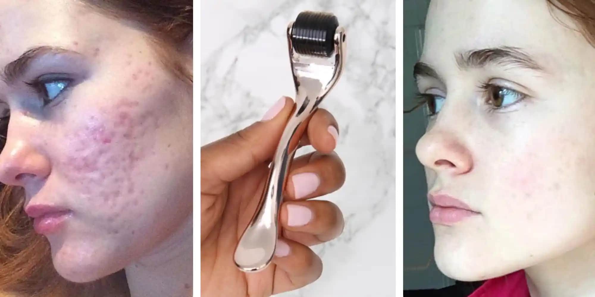 Dermaroller Uygulaması: Güvenli Kullanım ve Sonuçlar İçin Bilmeniz Gerekenler